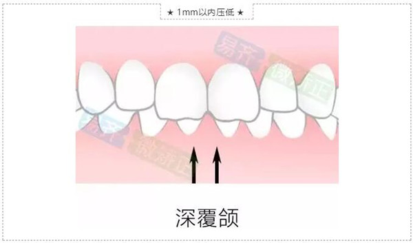 牙齒微矯適應(yīng)癥