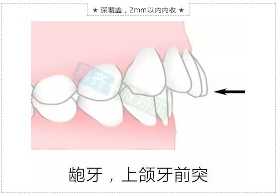 牙齒微矯適應(yīng)癥