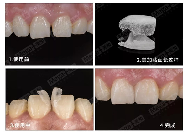 美加貼面修復(fù)過程