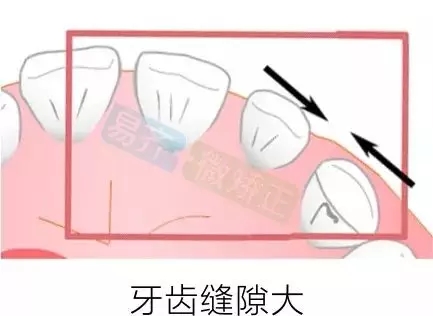 美加易齊微矯為您解決牙間隙問題