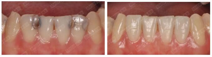 美加貼面修復前牙齲壞案例一