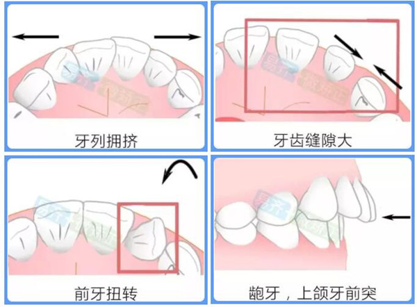 易齊微矯適應(yīng)癥