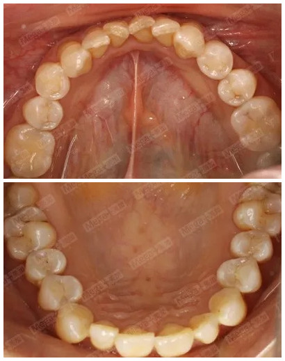 　術(shù)前上下頜照