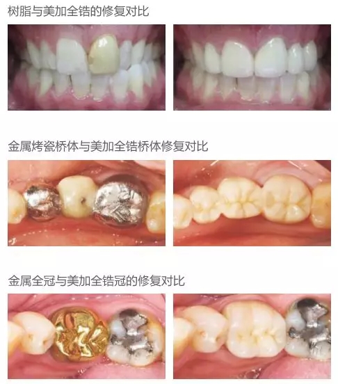 烤瓷牙變黃了，可以拆掉換成牙貼面修復(fù)嗎？