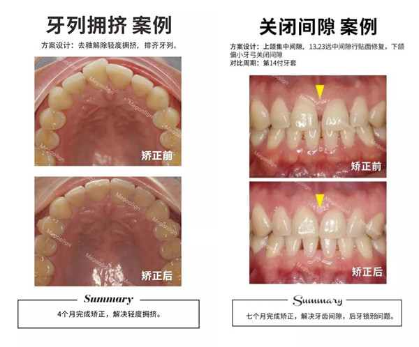 這樣的牙齒都適合用易齊微矯正