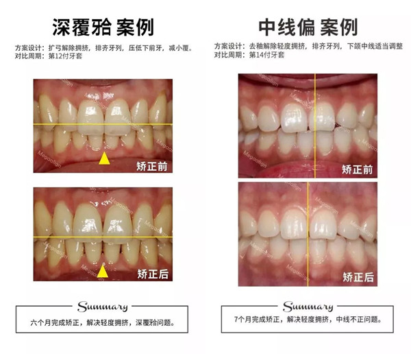 這樣的牙齒都適合用易齊微矯正