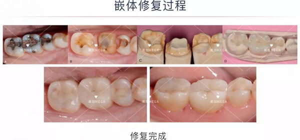 嵌體修復(fù)過程