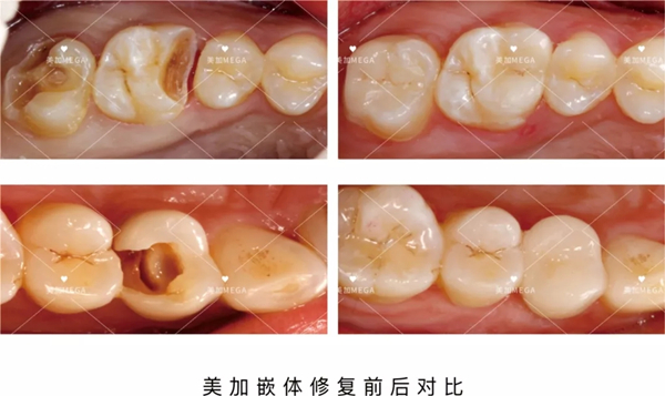 美加嵌體修復(fù)前后對比