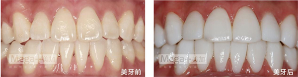 美加貼面增齡性齒黃修復案例