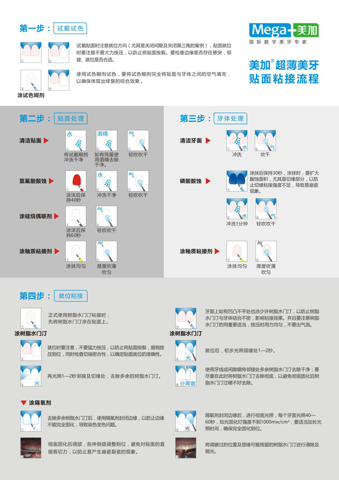 全瓷貼面粘接