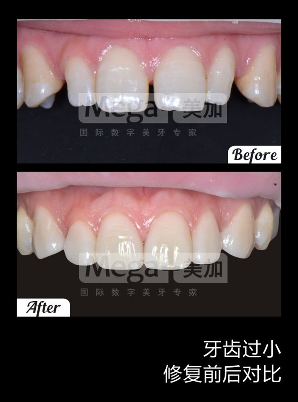 有兩顆牙齒小可以做牙貼面嗎