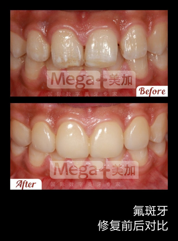 美加貼面修復(fù)氟斑牙案例