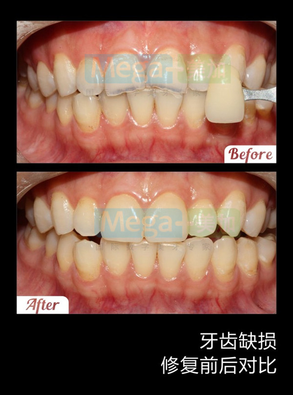 牙齒磕損可以做牙貼面嗎