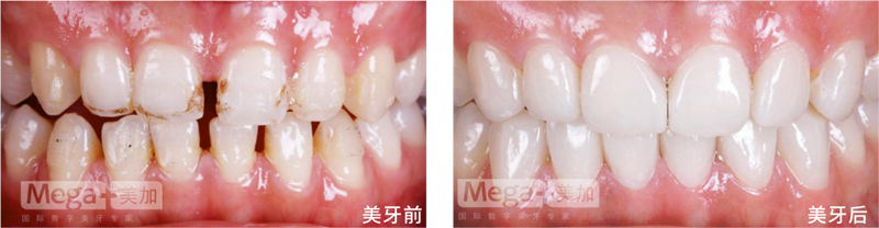 牙齒縫隙大做牙貼面好嗎