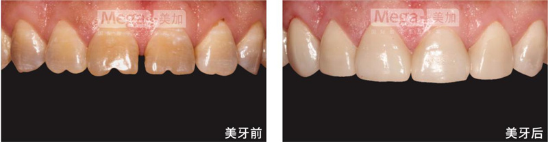 美加貼面修復(fù)瓜子牙前后