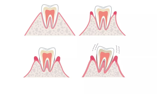 牙周病是牙齒松脫的主要原因