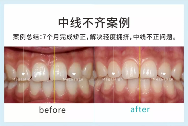 美加易齊微矯，成年人的隱形矯正方案