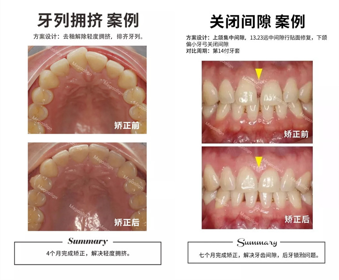 美加易齊微矯案例