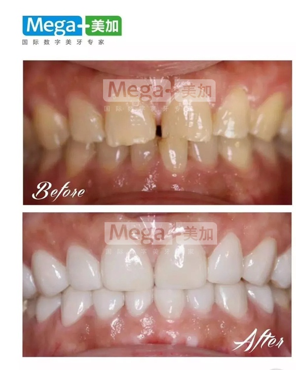 美加超薄瓷貼面關(guān)門牙縫案例