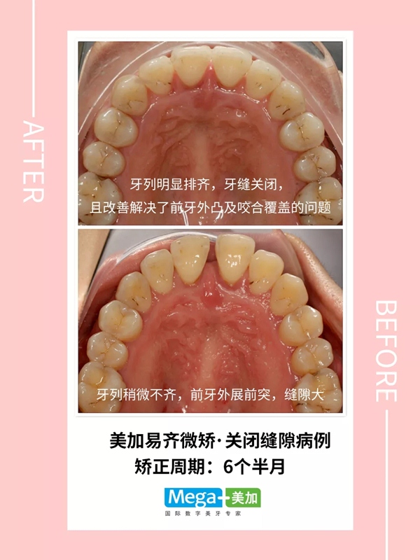 易齊微矯關(guān)閉牙縫隙案例