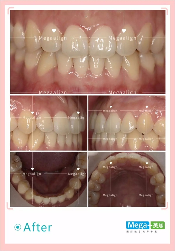 隱形矯正后口內(nèi)照