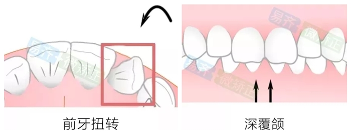 易齊微矯適應(yīng)癥