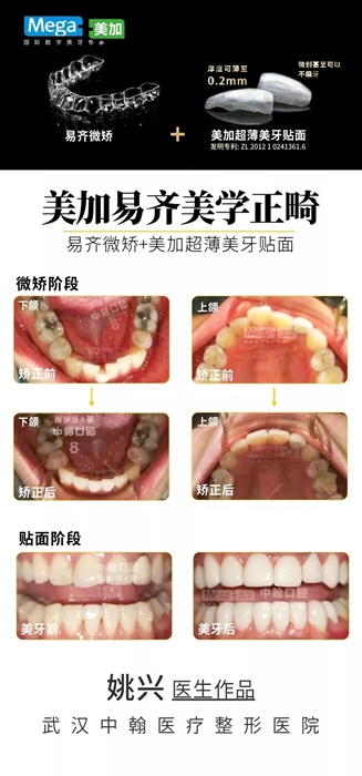 其他“微矯+貼面”案例