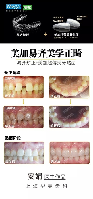 其他“微矯+貼面”案例