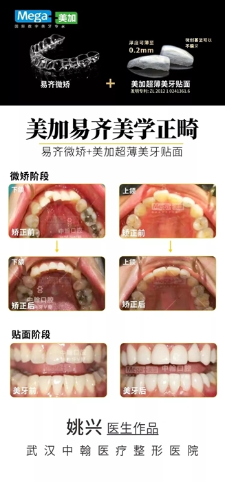 “微矯+貼面”案例