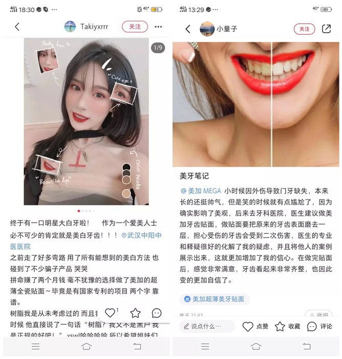 為什么他們都愿意在小紅書上種草美加貼面？