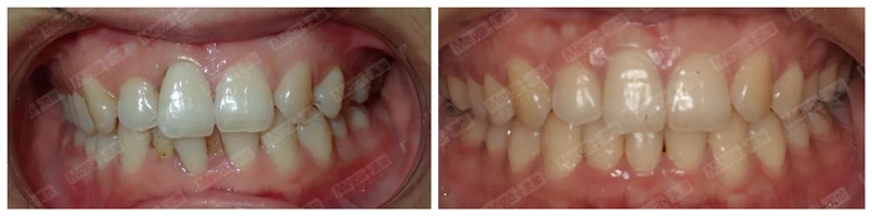 矯正前VS矯正后