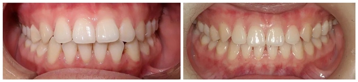 矯正前VS矯正后