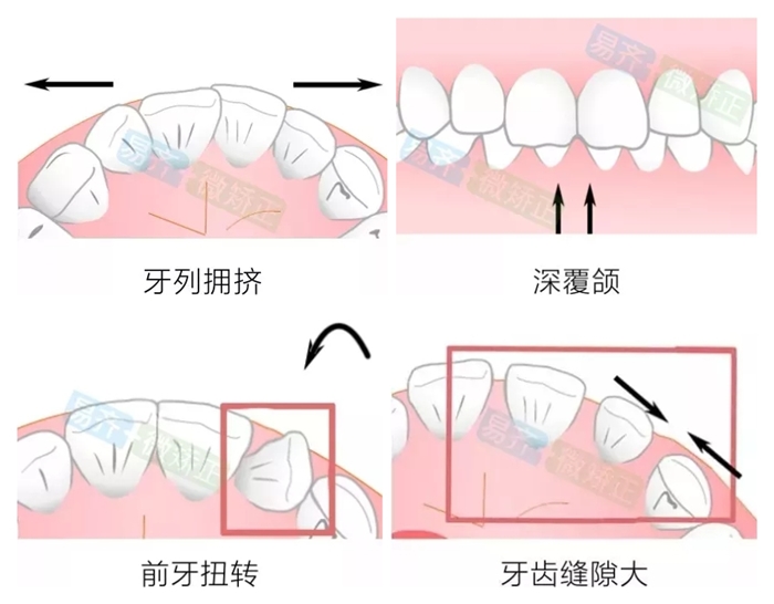 易齊微矯適應(yīng)癥