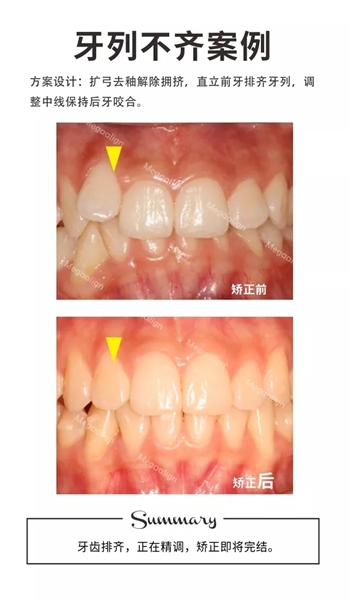 隱形矯正案例