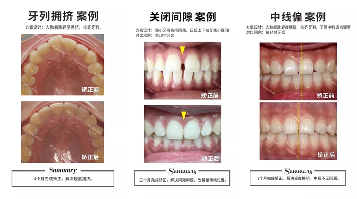 美加易齊微矯的以往案例