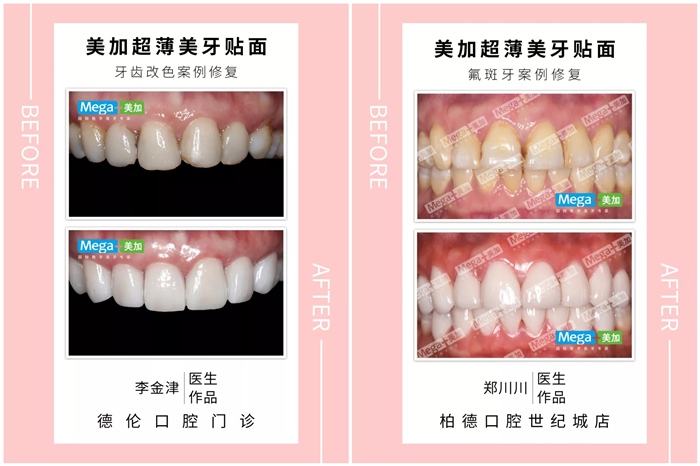 美加超薄美牙貼面案例