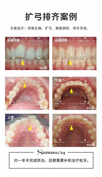 美加易齊矯正案例