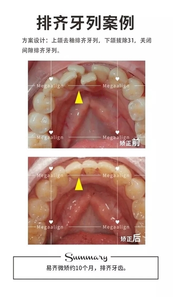 美加易齊矯正案例