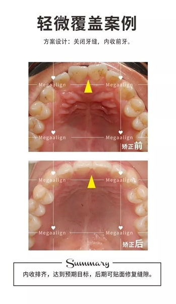 美加易齊矯正案例