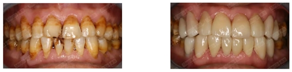 修復(fù)前后對比—口內(nèi)照
