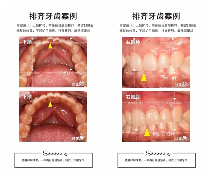 美加易齊隱形矯正案例