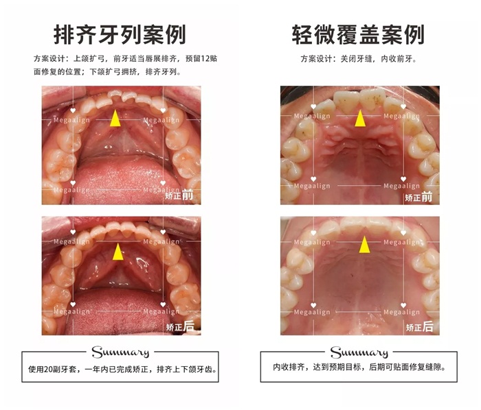 美加隱形矯正案例