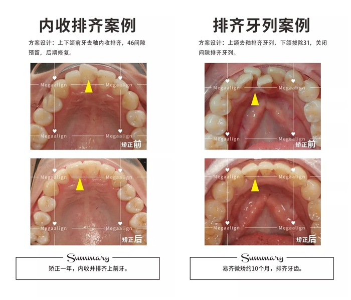 美加隱形矯正案例