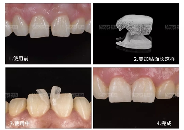 什么是牙齒貼片？