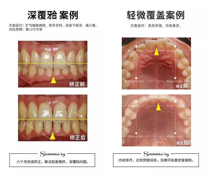 美加易齊隱形矯正深覆合案例