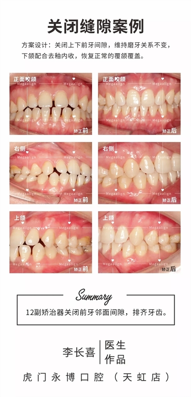 半年做完了易齊隱形微矯，效果還杠杠滴！