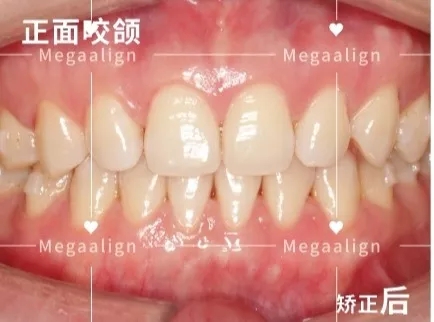 易齊微矯后效果