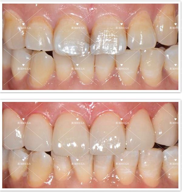 美加貼面修復輕度齲齒