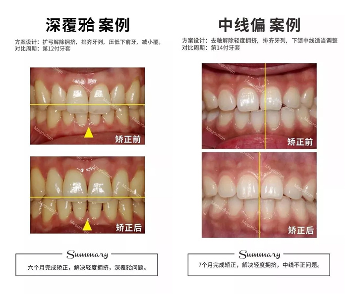 美加易齊微矯案例