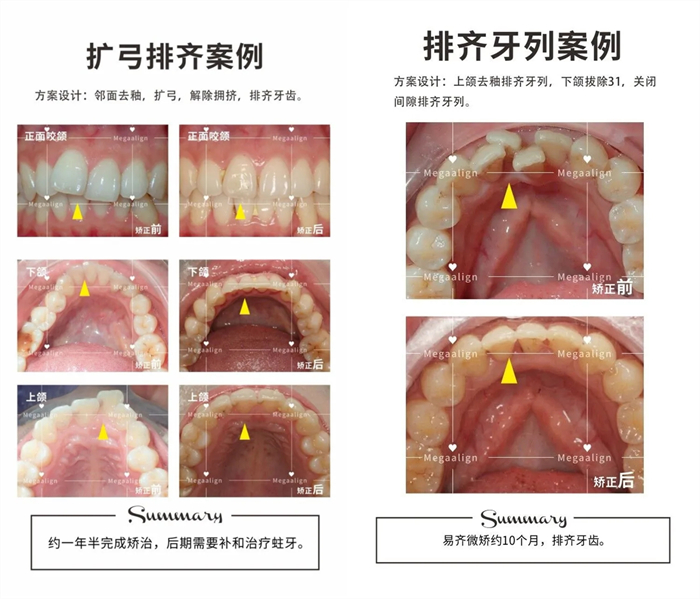 美加隱形矯正案例